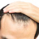 hair loss due to hair dye will it grow back